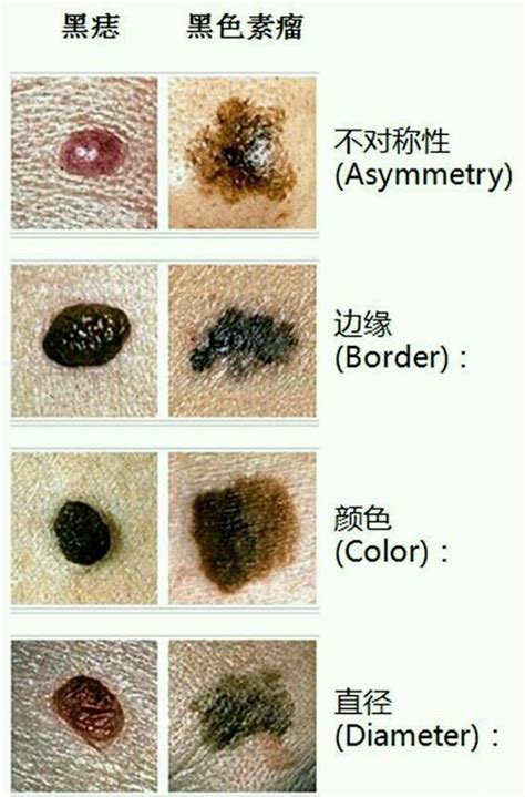 黑痣癌变早期|黑色素痣癌变的过程，早期症状